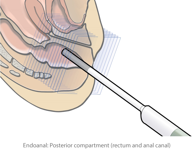Endoanal ultrasound