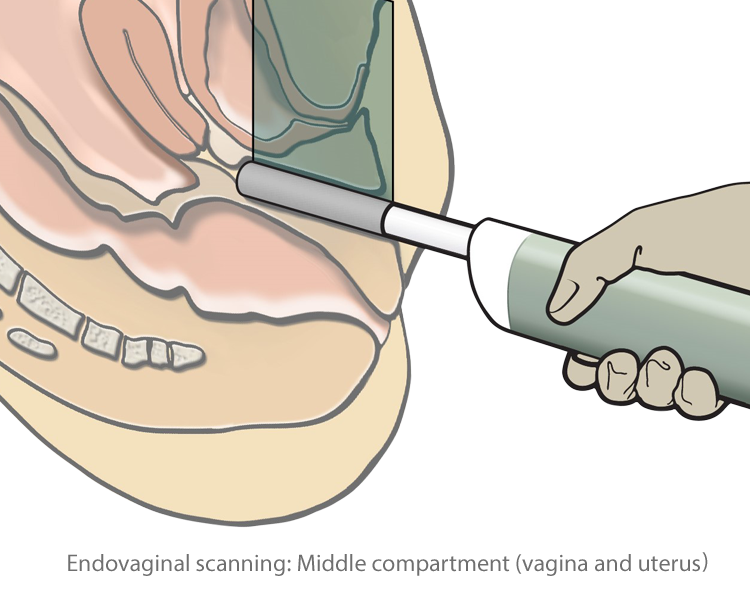 Endovaginal ultrasound scanning animation